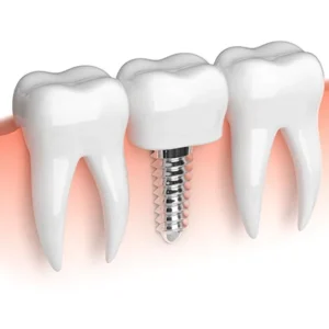 Is It Normal to Feel Sick After Dental Implants