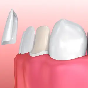 Dental Veneer